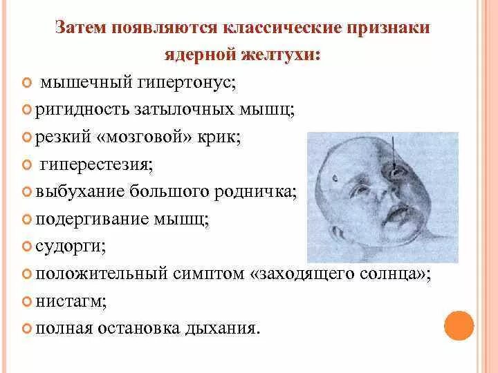 Симптом заходящего солнца симптом грефе. Симптом заходящего. Симптом заходящего солнца у новорожденных. Симптом заходящего. Симптом заходящего.
