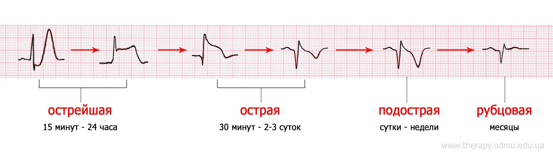 Экг подъем. Инфаркт в стадии рубцевания ЭКГ. ЭКГ инфаркт миокарда с подъемом St. Инфаркт ЭКГ элевация St. ЭКГ при инфаркте миокарда без подъема сегмента St.