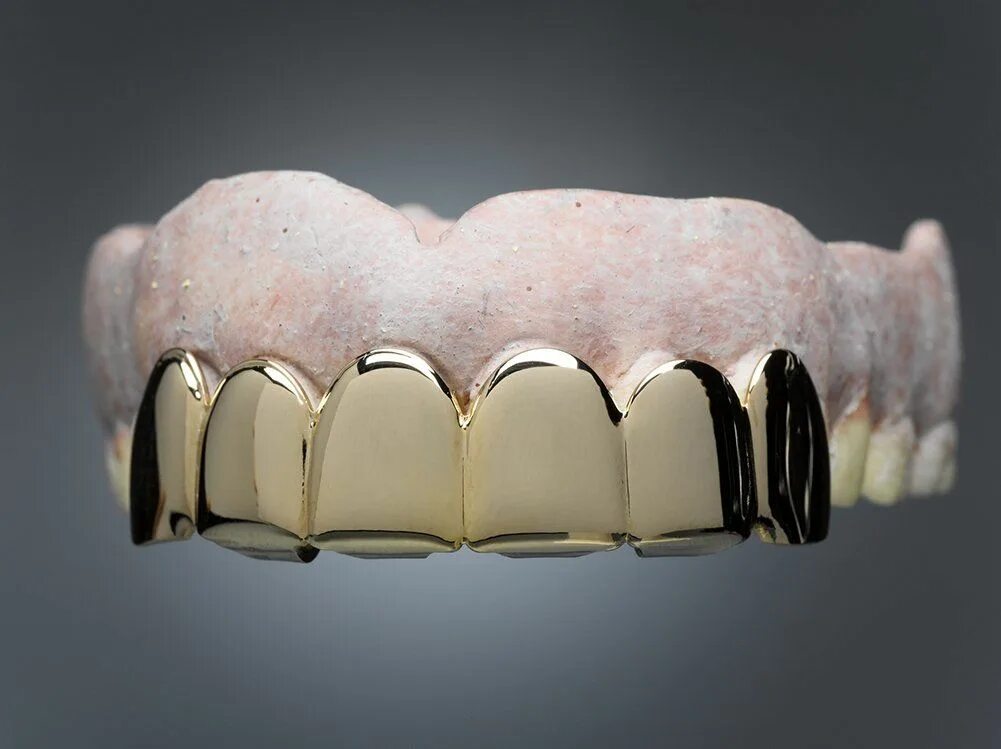Сколько стоит металлические зубы. Металлические протезы зубов. Металлический мостовидный протез. Металлическая коронка. Мостовидные протезы из золота.