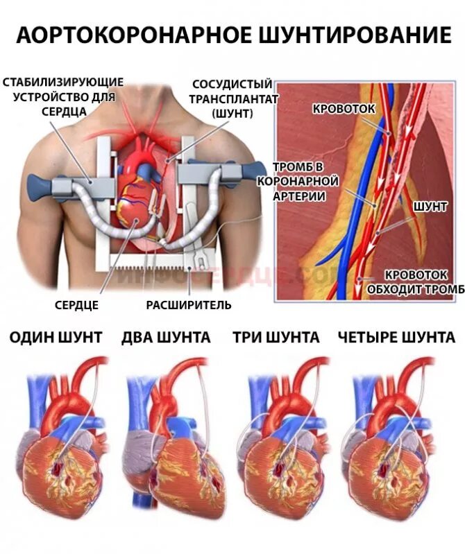 Замена клапана инвалидность