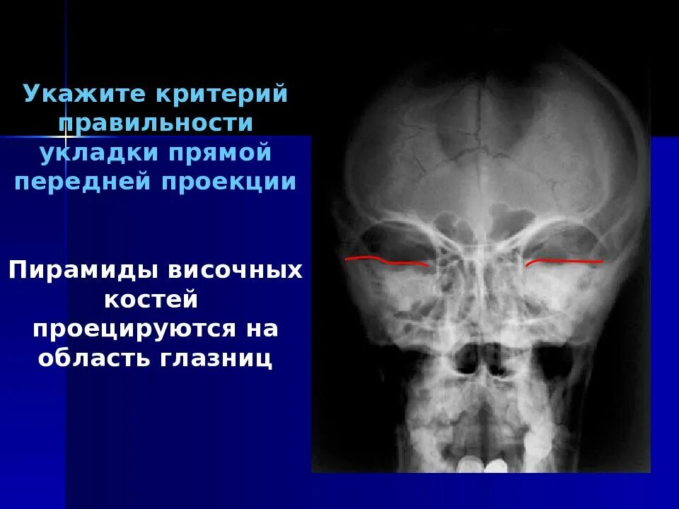 Проекции рентгенограмм черепа. Рентгеноанатомия черепа в прямой проекции. череп рентген анатомия. рентгеноанатрммя череп. рентгенанатомия церема.