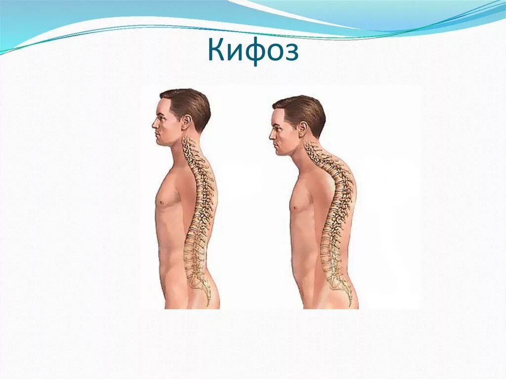 Грудной кифоз выражен. Осанка лордоз и кифоз. позвонок лордоз кифоз. лордоз грудного отдела позвоночника. кифоз грудного отдела позвоночника.