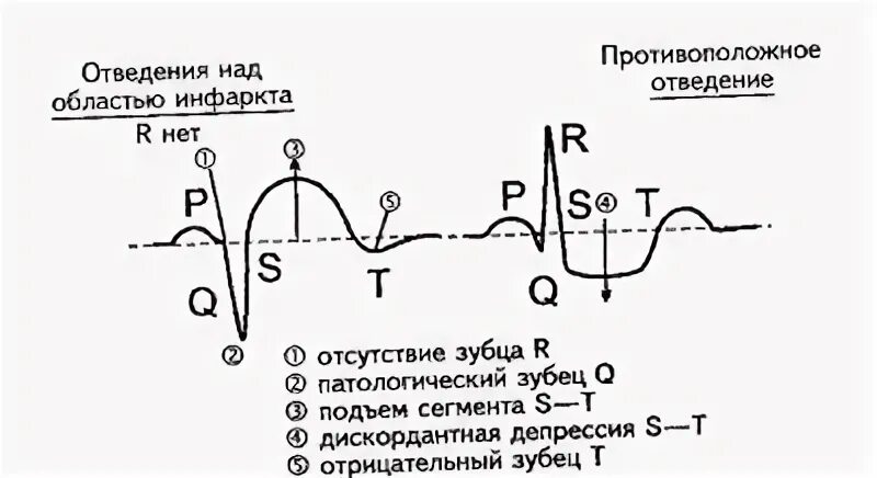 Патологический зубец q