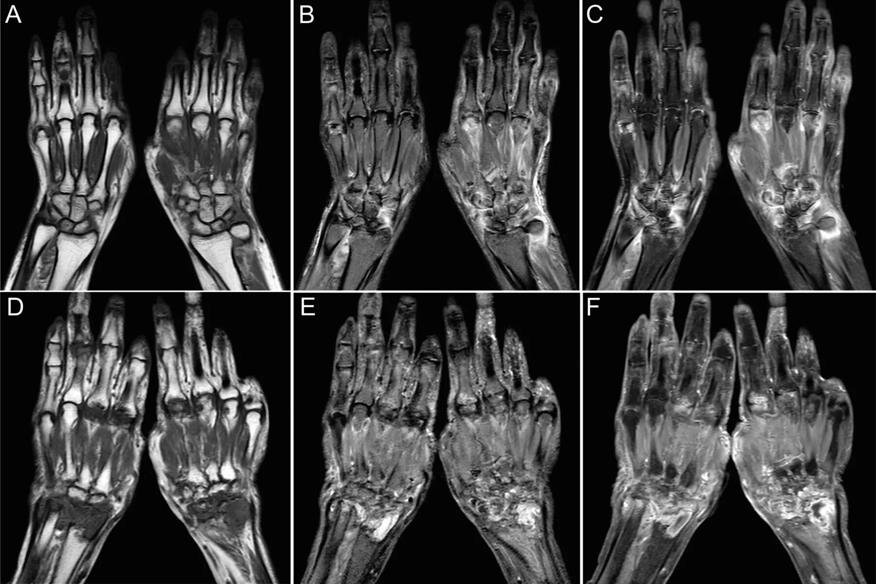 Делают ли мрт руки. Ревматоидный артрит мрт кисти. Ревматоидный артрит кисти кт. Синовит лучезапястного сустава мрт. Ревматоидный артрит лучезапястного сустава мрт.
