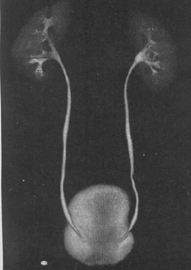 Обструкция мочеточника. Мегауретер экскреторная урограмма. Обструкция мочеточника урография.