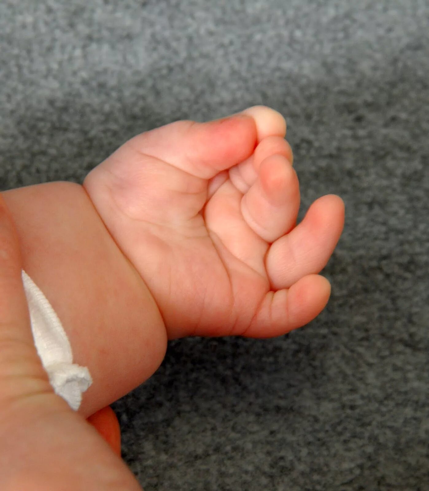 6 пальцев на руках у детей. Многопалость (полидактилия) мутация.
