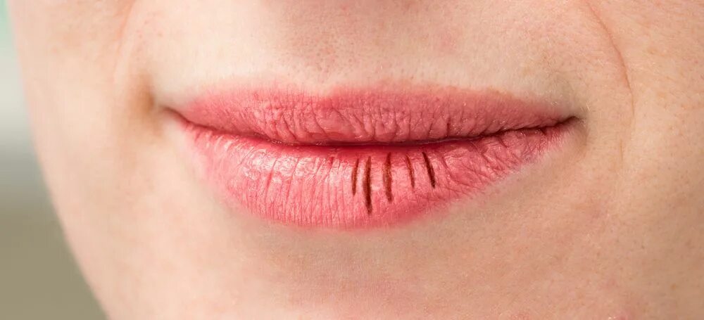 Broken lips. Broken lips