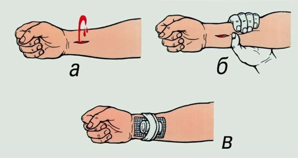 Остановка кровотечения из лучевой артерии