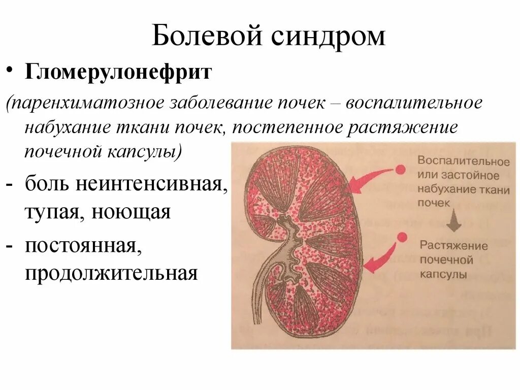 Исход заболеваний почек. Гломерулонефрит болевой синдром. Гломерулонефрит мочевыделительная система. Синдромы при заболеваниях почек гломерулонефрите. Первичное поражение почек.