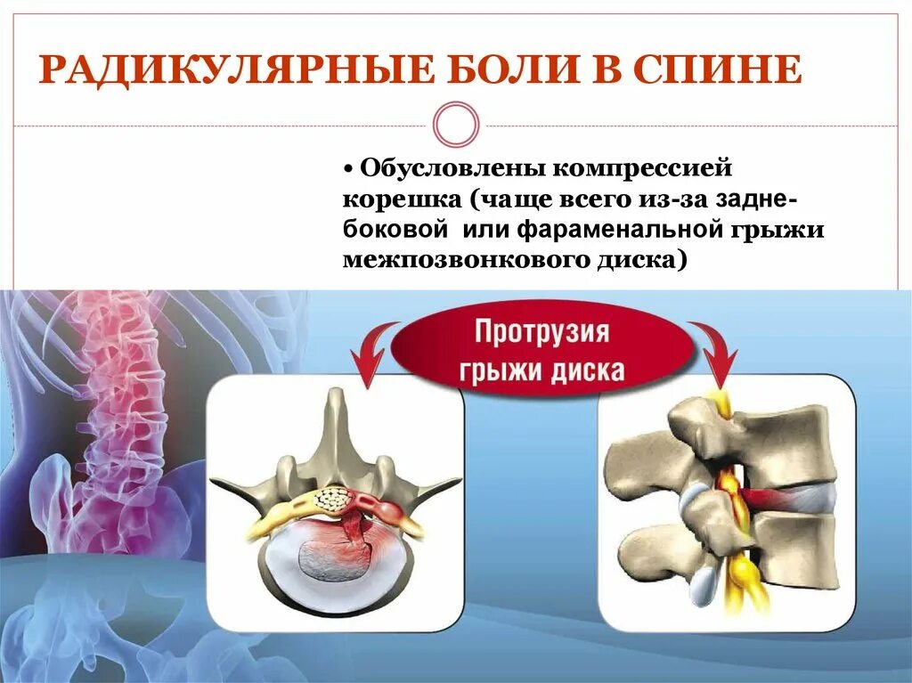 Люмбоишиалгия карта вызова. Радикулярные боли. Люмбалгия. Строение межпозвоночного диска. Спондилогенная люмбалгия.