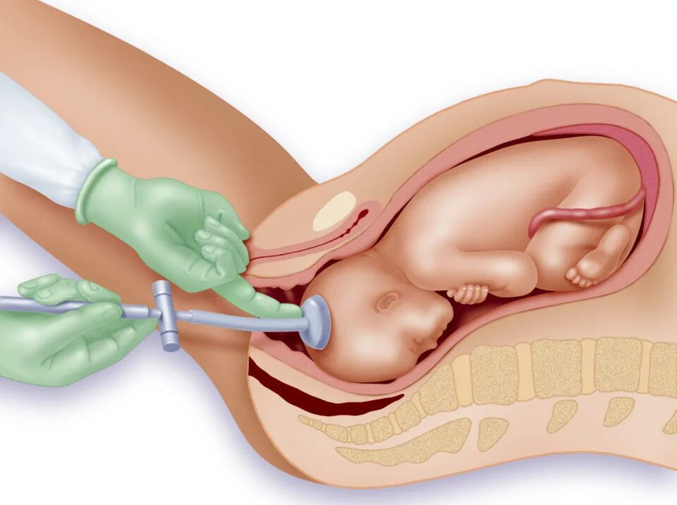 Накачали матку. Вакуум экстракция плода. Акушерские щипцы и вакуум-экстракция плода. Вакуум экстрактор акушерский. Вакуум-экстрактор для родовспоможения.