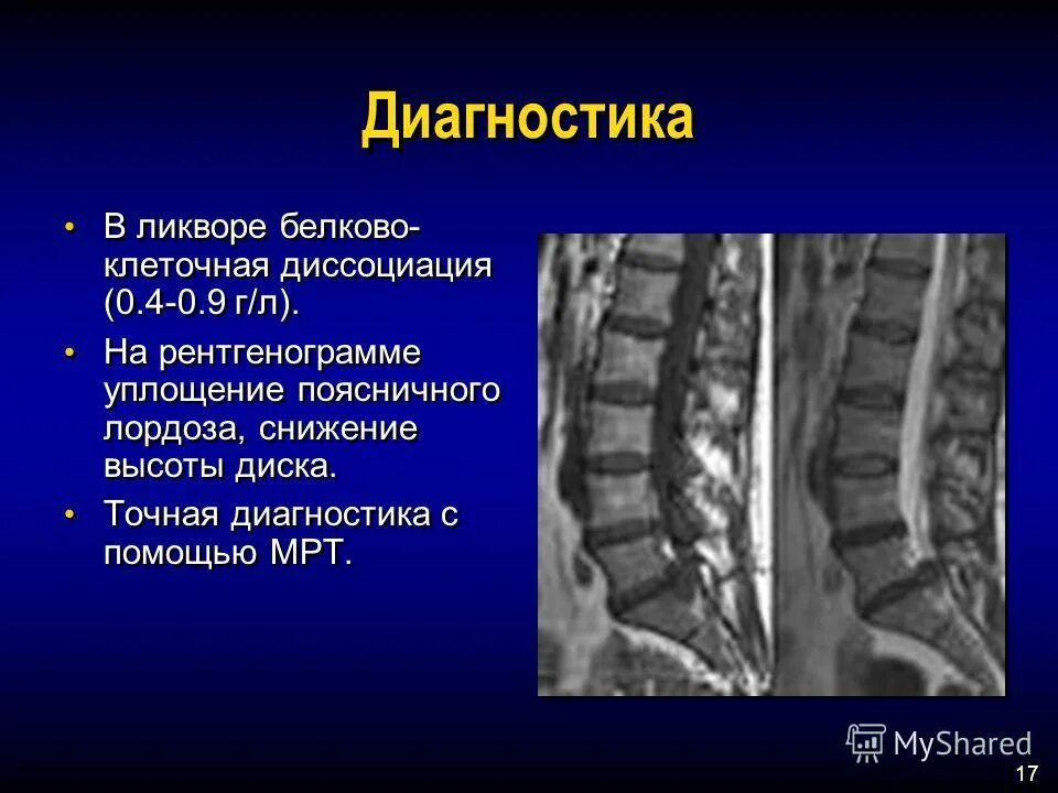 Краевые остеофиты шейного отдела позвоночника. Краевые костные разрастания позвонков. Снижение высоты дороге. Снижение высоты диска. Снижение высоты межпозвоночного диска.