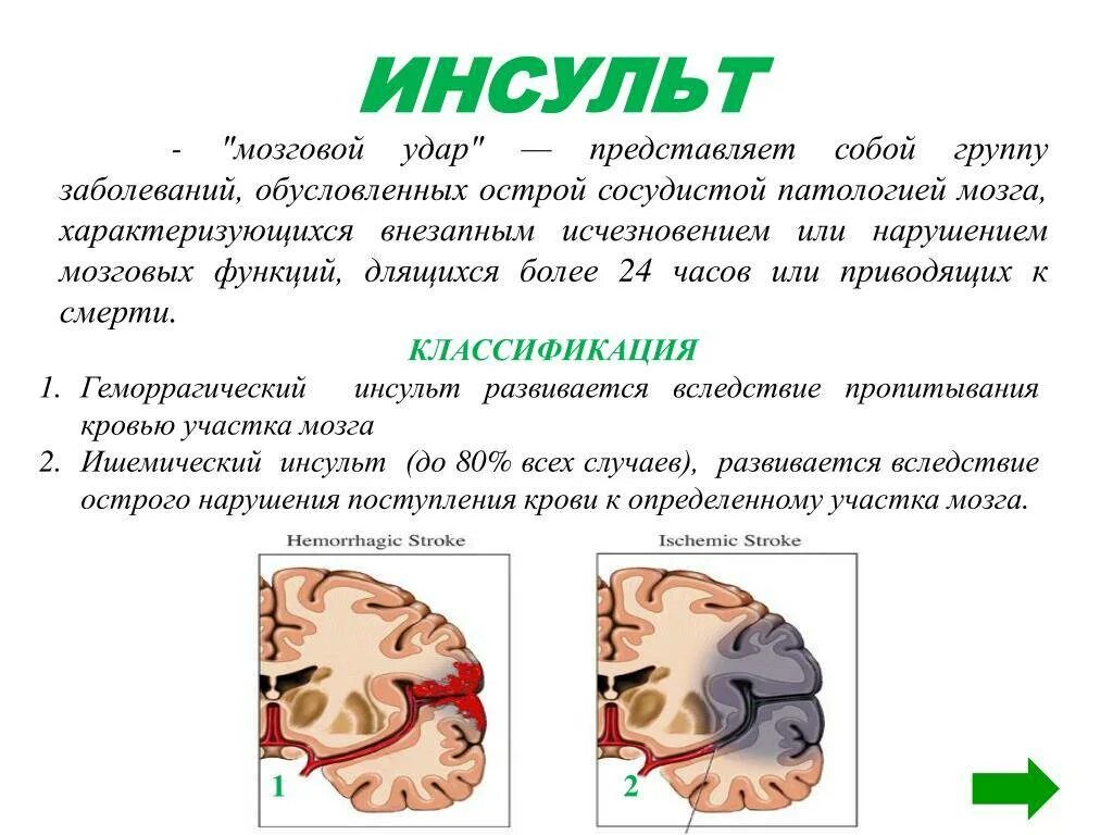 Инсульт правая сторона мозга последствия. Инсульт. Исудьт.