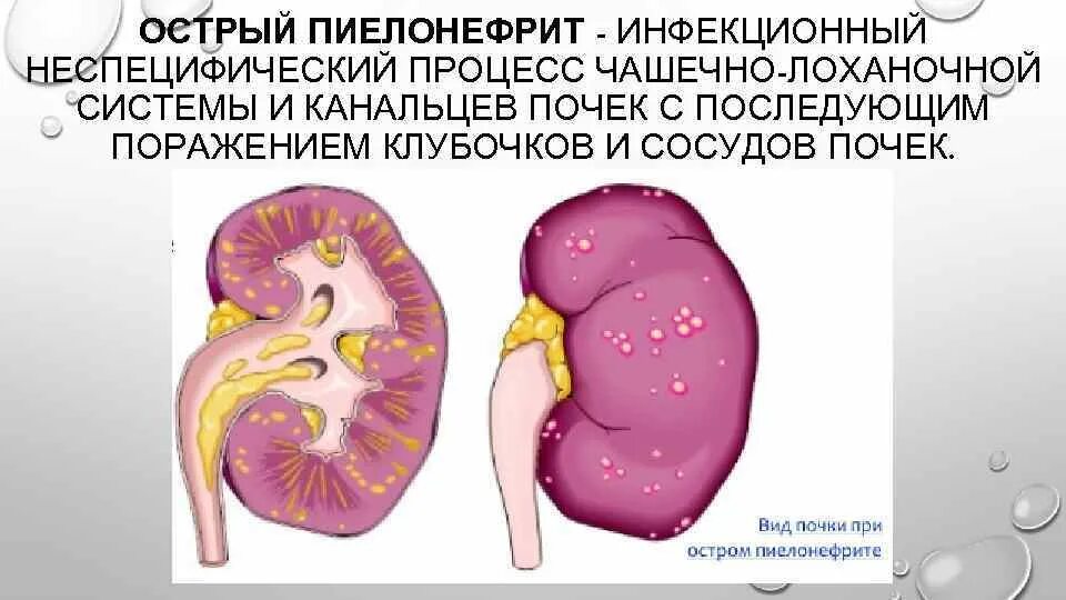 Гнойный пиелонефрит гистология. Острый левосторонний пиелонефрит. Острый пиелонефрит почка. Пиелит это