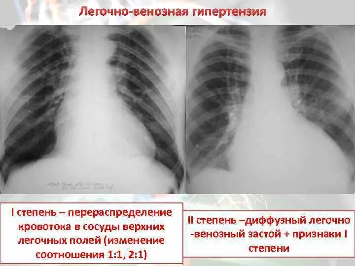 Легочная венозная гипертензия рентген. Легочная артериальная гипертензия рентген. Легочная венозная гипертензия степени. Легочно венозная гипертензия на рентгенограмме. Застойные изменения в легких