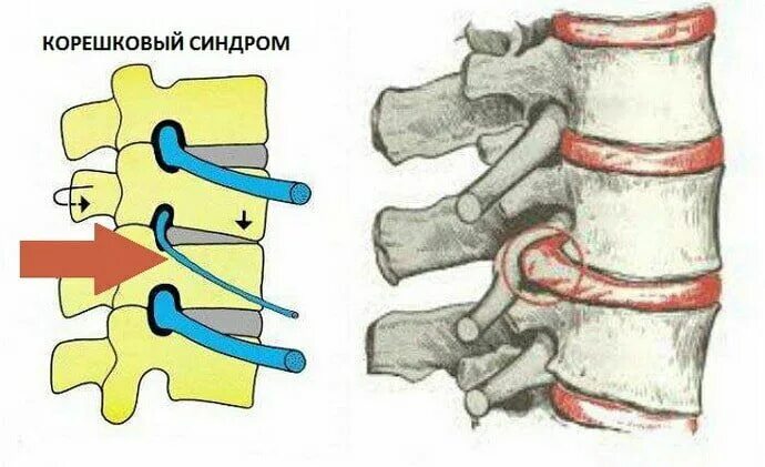 Корешковые нервы в пояснице. Сдавление Корешков спинномозговых нервов. Корешковый синдром с1. Радикулопатия s1 Корешков. Корешковый синдром l5.