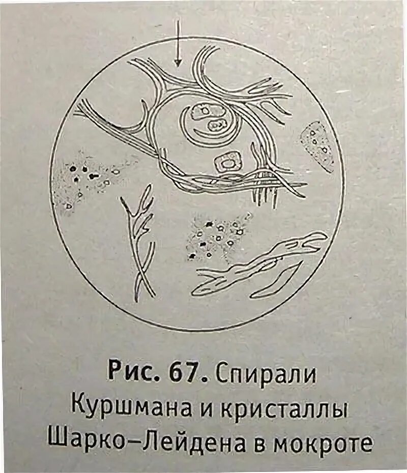 Кристаллы шарко лейдена. Кристаллы шарко лейдена