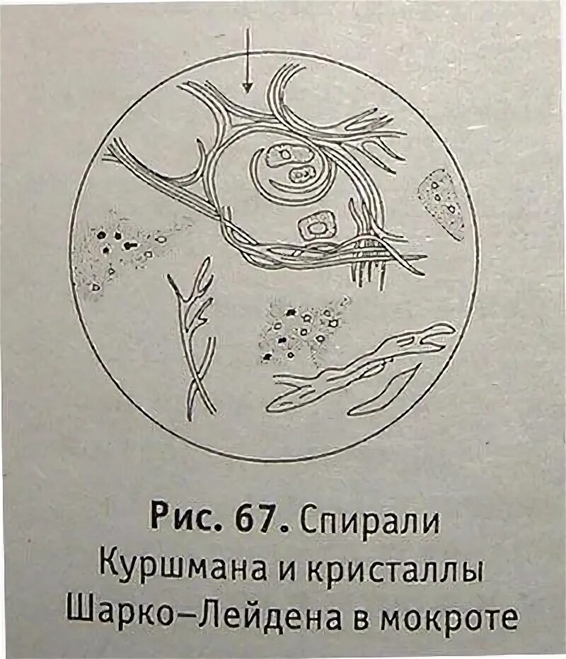 Шарко лейдена в кале. Кристаллы Шарко-Лейдена в мокроте. Спирали Куршмана и Кристаллы Шарко-Лейдена. Эластические волокна в мокроте микроскопия. Спирали Шарко Лейдена в мокроте.