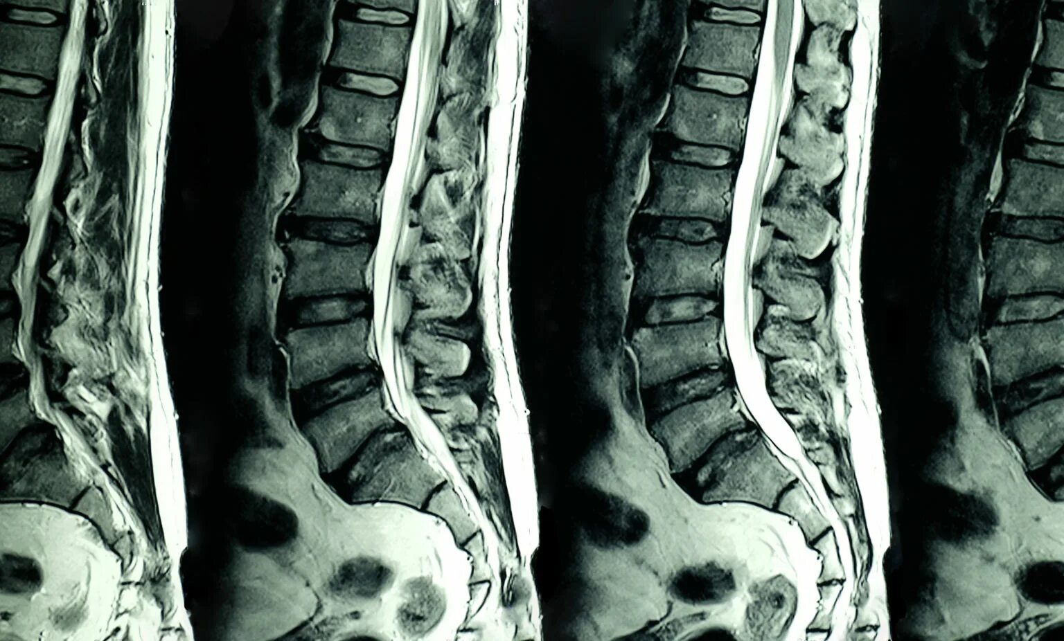 Мрт пояснично крестцового отдела тазобедренные суставы. Мрт l-spine. остеопороз позвоночника поясничного отдела на мрт. мрт пояснично-крестцового отдела позвоночника грыжа. грыжа на кт позвоночника.
