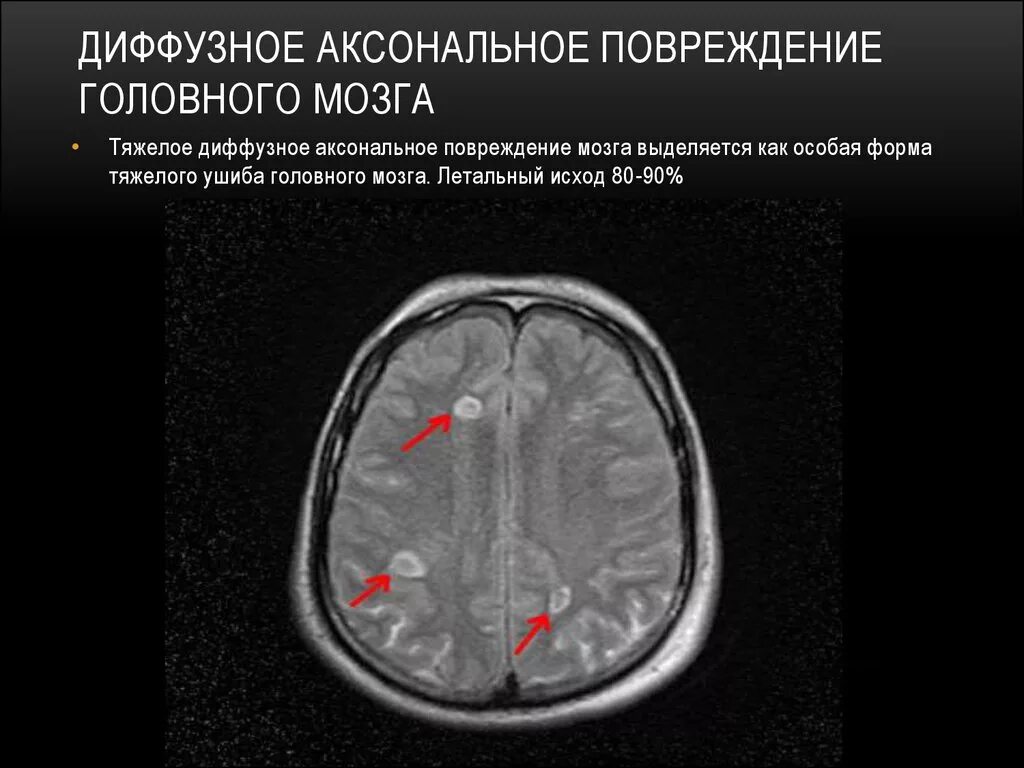 Тяжелое поражение головного мозга. Диффузные аксональные повреждения головного мозга мрт. Диффузно аксональные повреждения головного мозга кт. Диффузное аксональное повреждение ДАП головного мозга. Диффузное аксональное повреждение головного мозга ЧМТ.