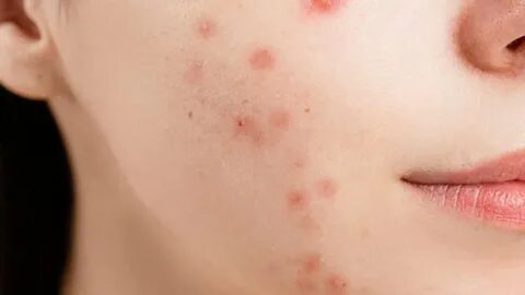 Foto Cara Menghilangkan Bekas Jerawat Secara Alami: Rahasia Kulit Mulus Tan...