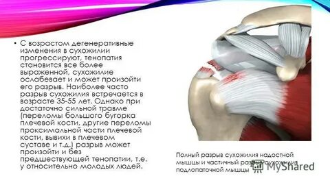 Сухожилие плечевого сустава лечение