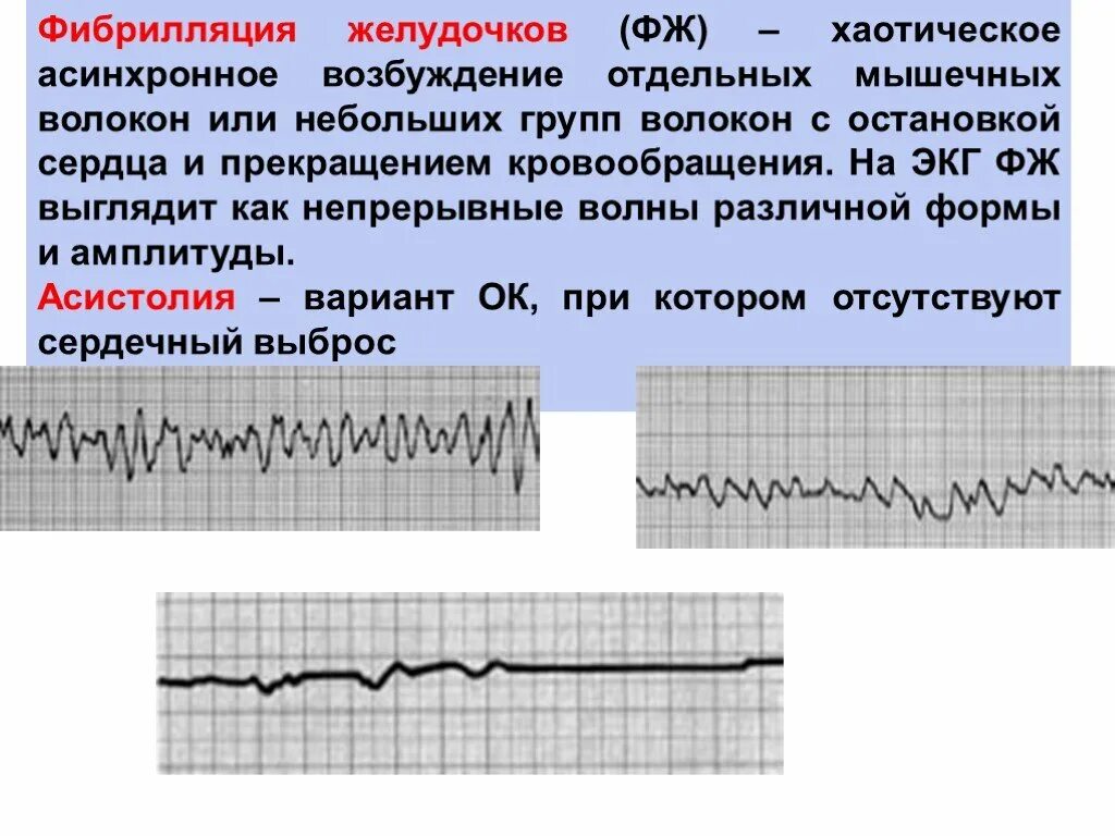 Фибрилляция желудочков. Фибрилляция желудочков на ЭКГ фото. Варианты остановки кровообращения. Трепетание желудочков ЭКГ собаки Ветеринария.