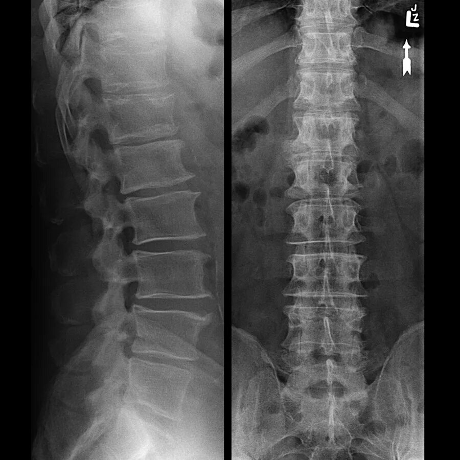 Спондилит поясничного отдела рентген. Спондилит поясничного отдела позвоночника рентген. Ротация позвонков поясничного отдела рентген. Рентген дорсального отдела позвоночника. Рентгенография позвоночника в 2 х проекциях