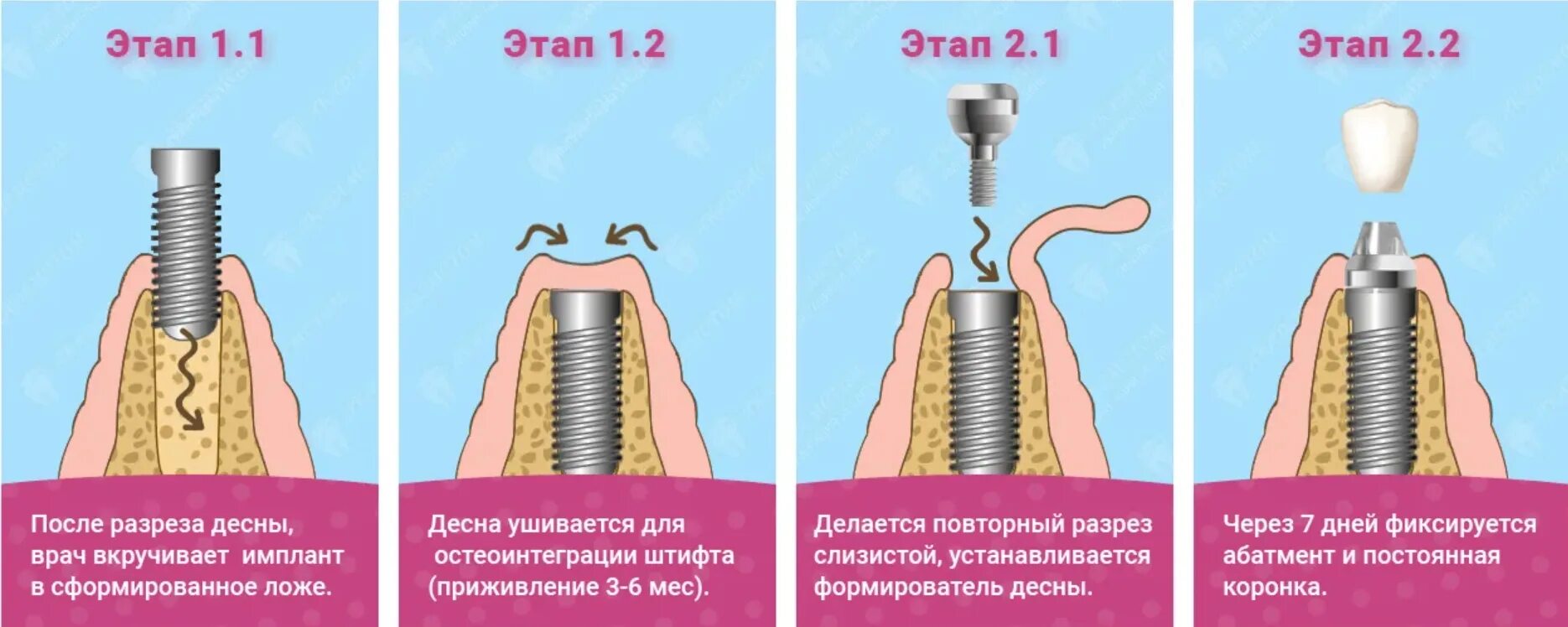 Насколько установлен. Двухэтапная методика имплантации зубов. Этапы имплантации зуба абатмент. Двухэтапная имплантация зубов этапы. Импланты схема установки.