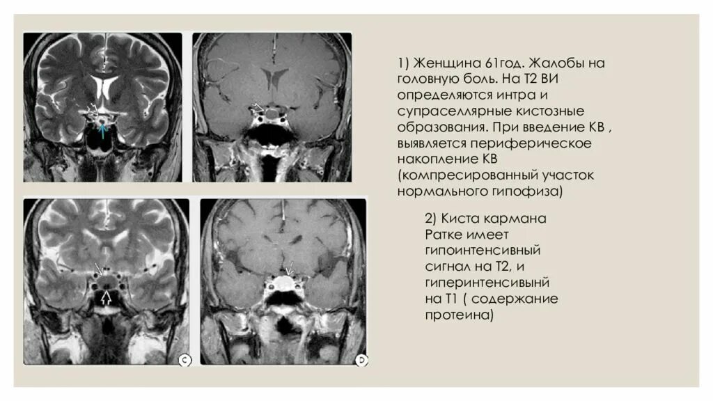 Размер гипофиза. Микроаденома мрт. Аденома гипофиза РКТ. Кистозная форма микроаденомы гипофиза мрт. Т1 т2 мрт гипофиза.