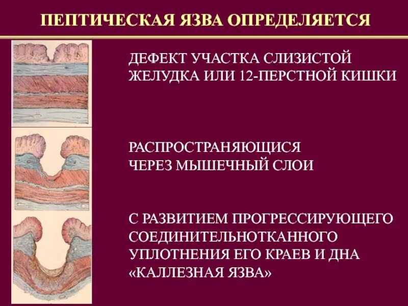 Хирургические заболевания желудка. Пенетрирующая язва желудка. Пептическая язва желудка. Язвенный дефект желудка. Каллезная пенетрирующая язва желудка.