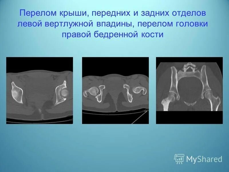 Перелом вертлужной впадины мкб. Перелом вертлужной впадины мкб. Полипроекционная рентгенография таза. Перелом вертлужной впадины клиника. Перелом вертлужной впадины мкб.