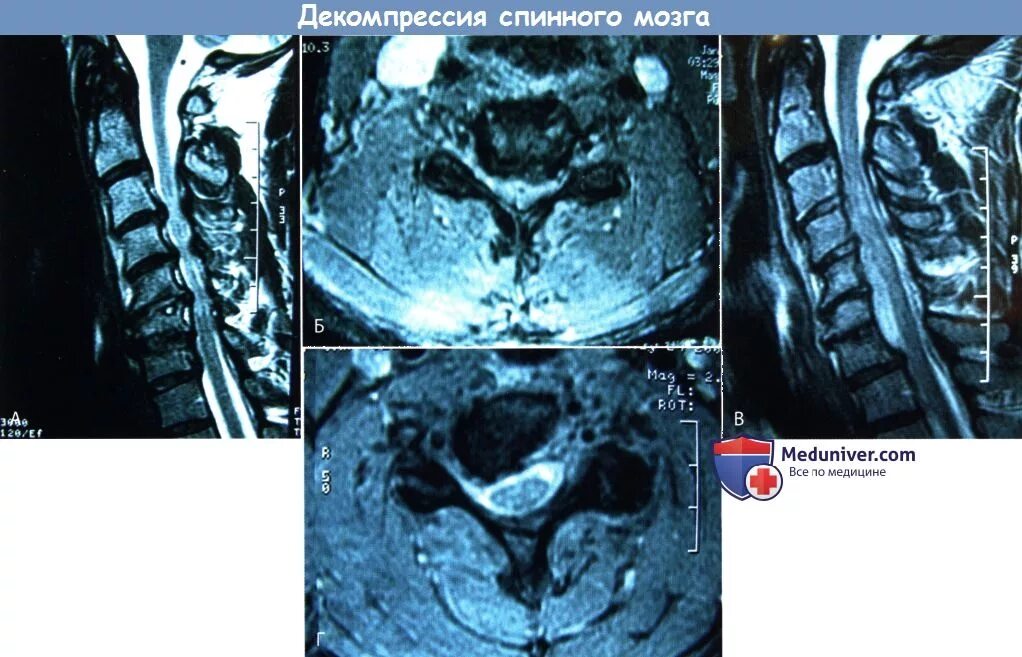 Декомпрессия спинного мозга операция. Передняя декомпрессия позвоночного канала. Передняя декомпрессия спинного мозга. Операция декомпрессия позвоночного канала.