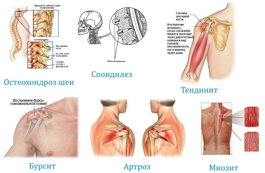 Заболевания плечевого сустава. Плечевое заболевание. Лечение остеохондроз плечевых