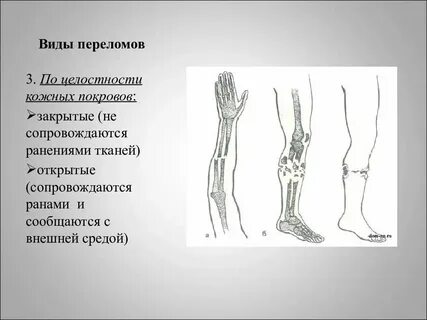 Перелом кости стопы симптомы