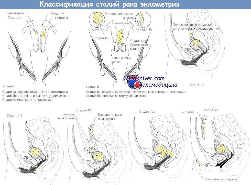 Классификация TNM опухолей матки. Классификация стадий эндометрия. Опухоли эндометрия классификация. Классификация Figo тело матки. Рак эндометрии лечение