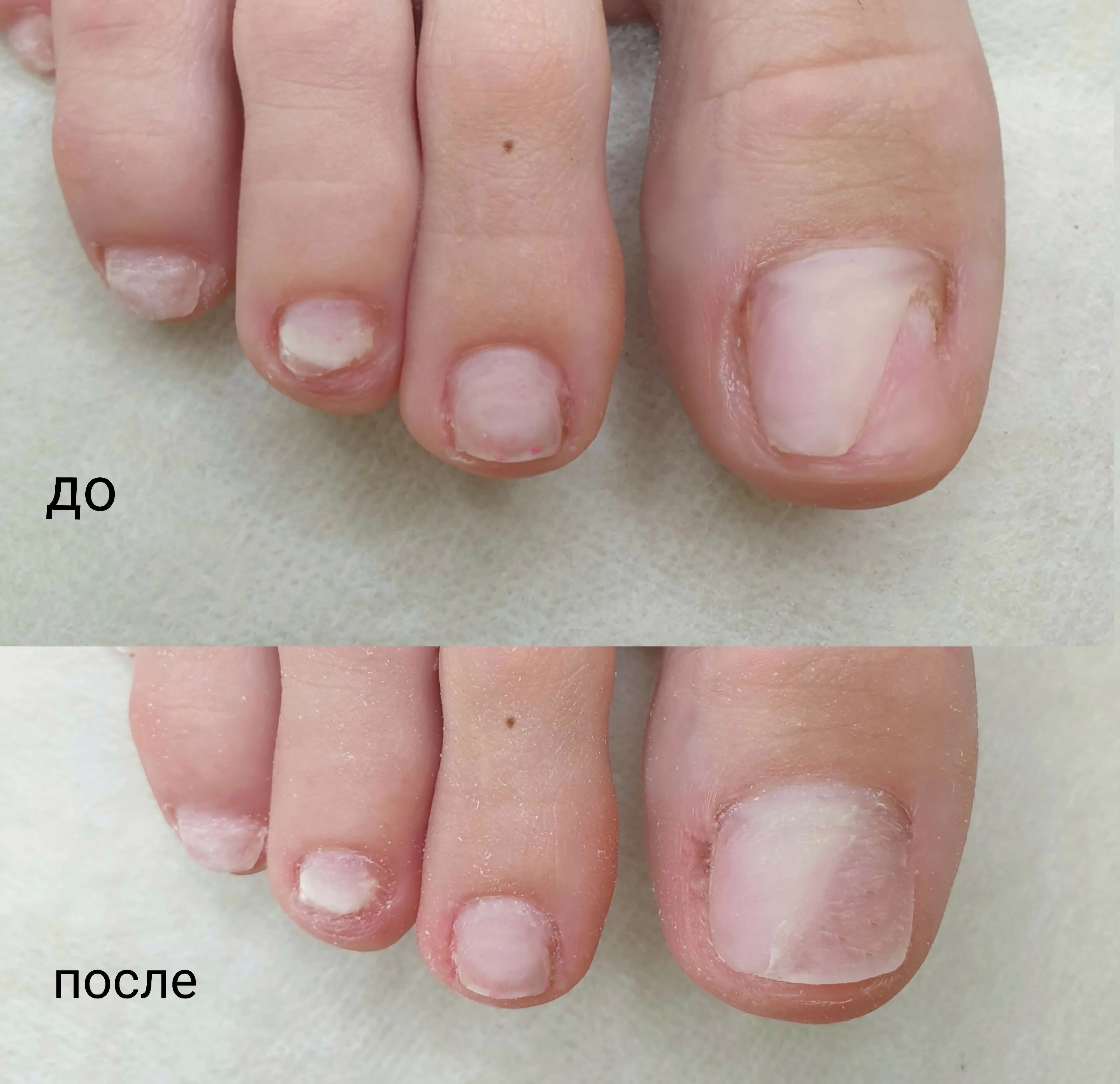 Подолог ногти на ногах. Мужской педикюр френч. Ногти на ногах намазаны. Онихомикоз ( обработка грибковых ногтей). Коррекция вросшего ногтя podofix.