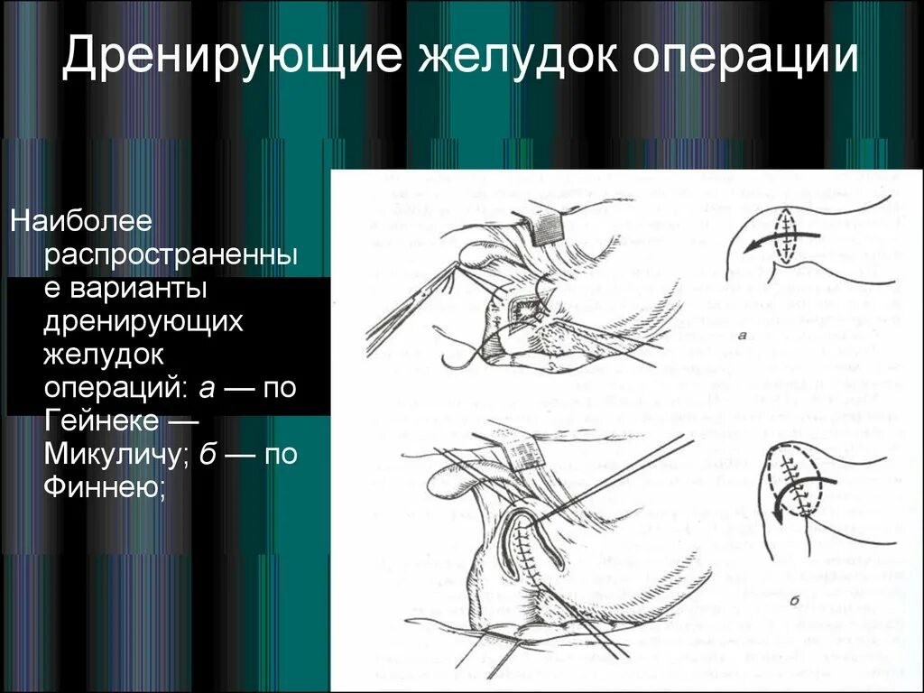 Дренирующие операции при язвенной болезни. Ваготомия с дренирующими желудок операциями. Дренирующие операции при ваготомии. Операции дренирующие привратник.