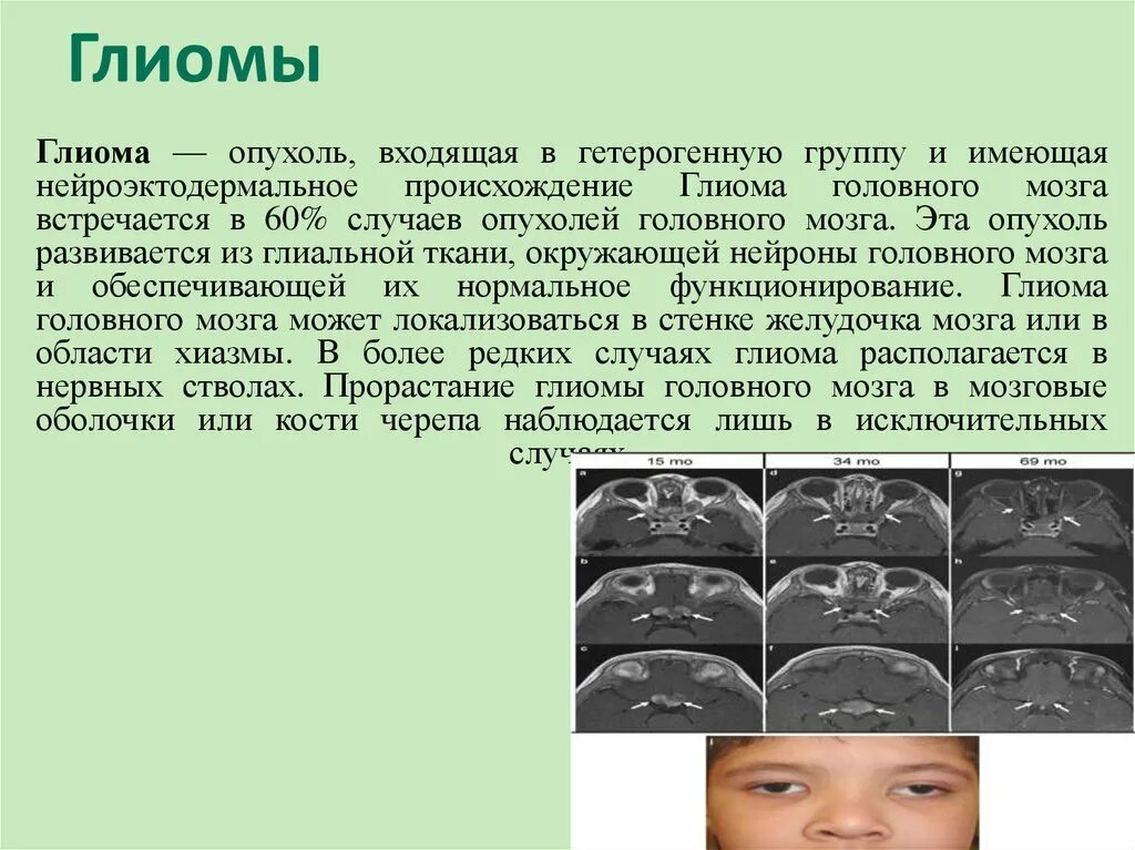 Глиома у детей. Глиома зрительного нерва симптомы. Глиома ствола головного мозга. Диффузная глиома ствола. Глиома ствола головного мозга у детей симптомы.