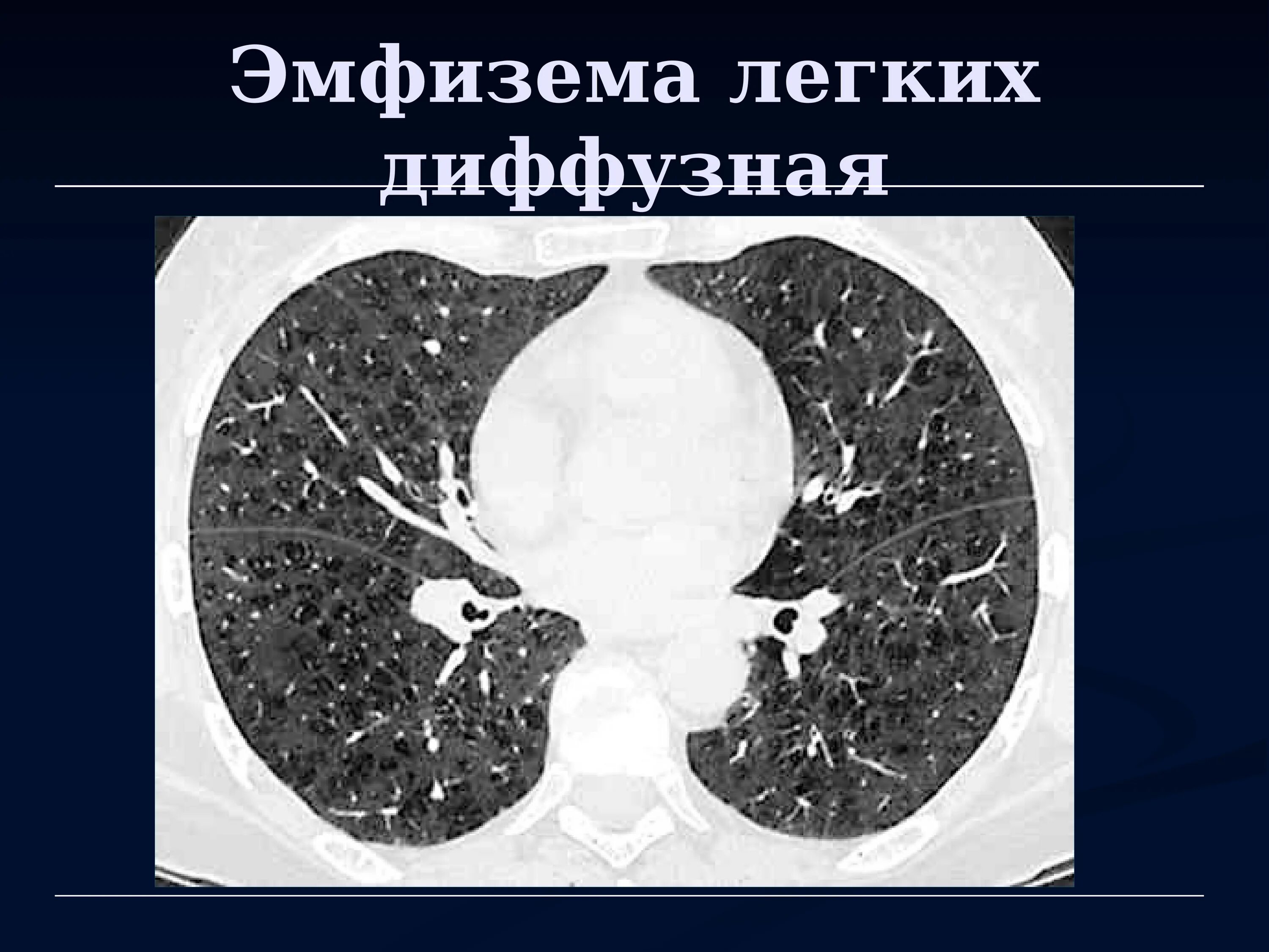 Центрилобулярная эмфизема на кт. Парасептальная эмфизема легких на кт. Диффузная эмфизема легких на кт. Диффузный пневмосклероз это рак