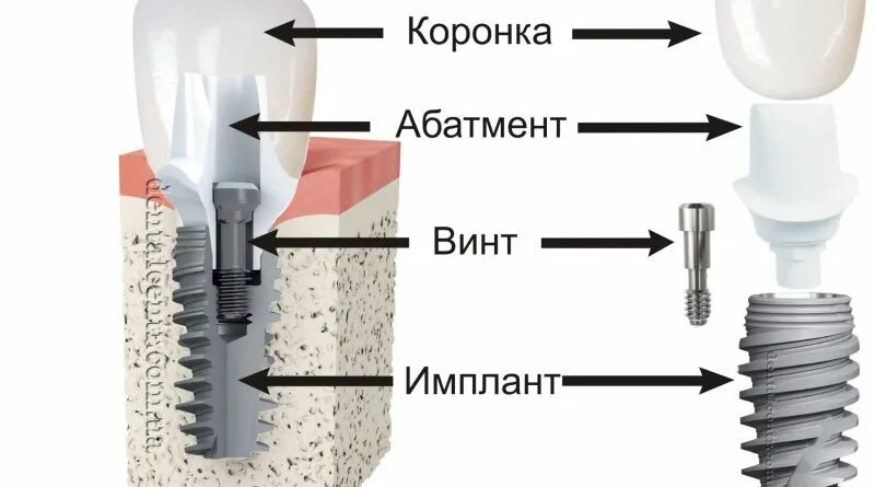 Абатмент что это такое фото. Имплант формирователь абатмент. Импланты Нобель и формирователь десны. Имплантат состоит из. Строение имплантата.