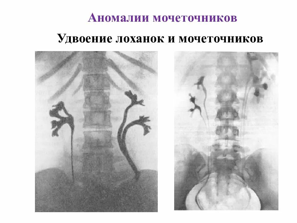 Два мочеточника. Удвоение почечных лоханок кт. Неполное удвоение почки урография. Удвоение почки экскреторная урография. Аномалия развития мочеточников классификация.