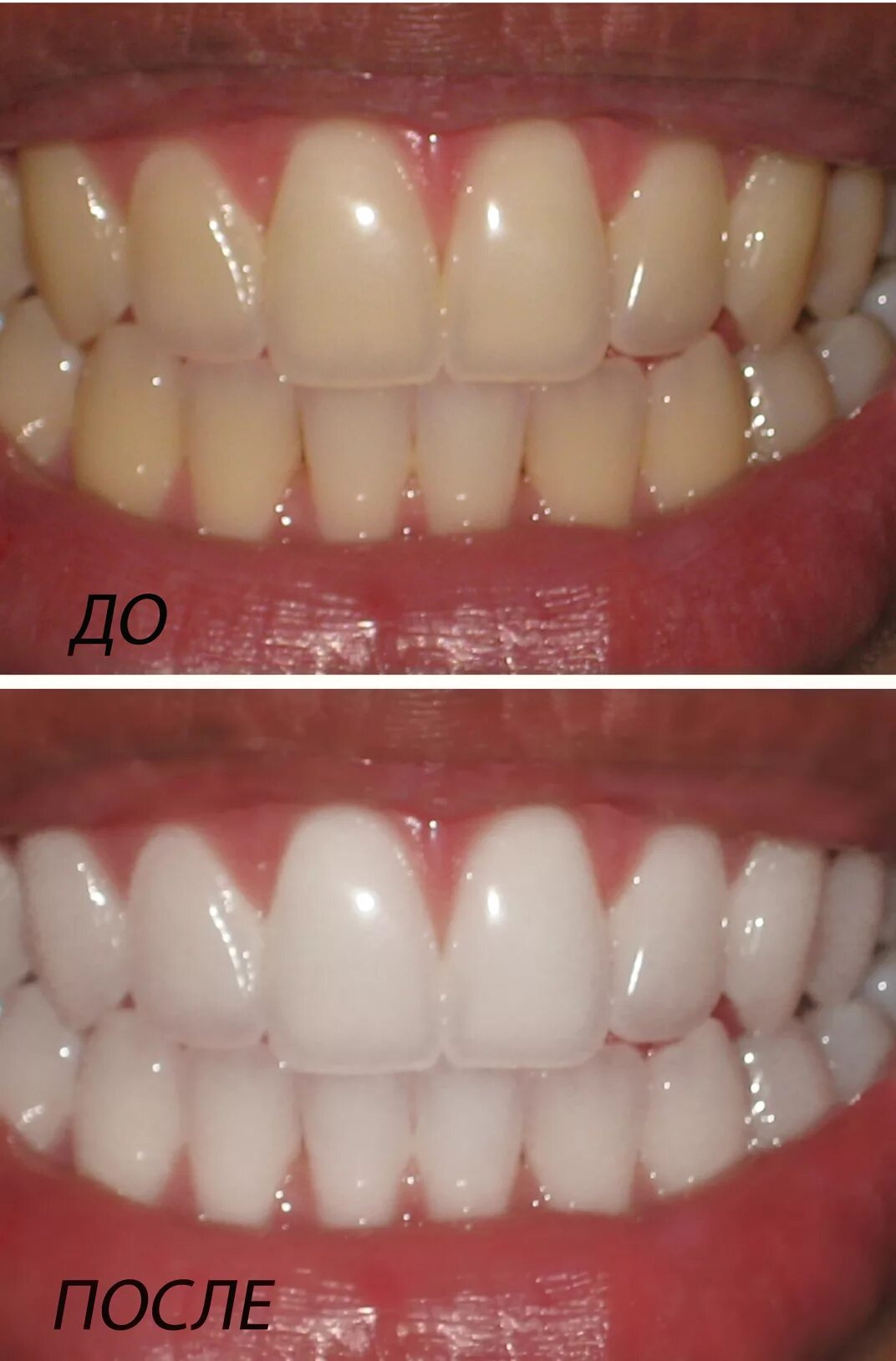 Отбеливание зубов минусы. Отбеливание зубов. Лазерное отбеливание зубов. Отбеливание зубов до и после. Зубы до и после отбеливания.