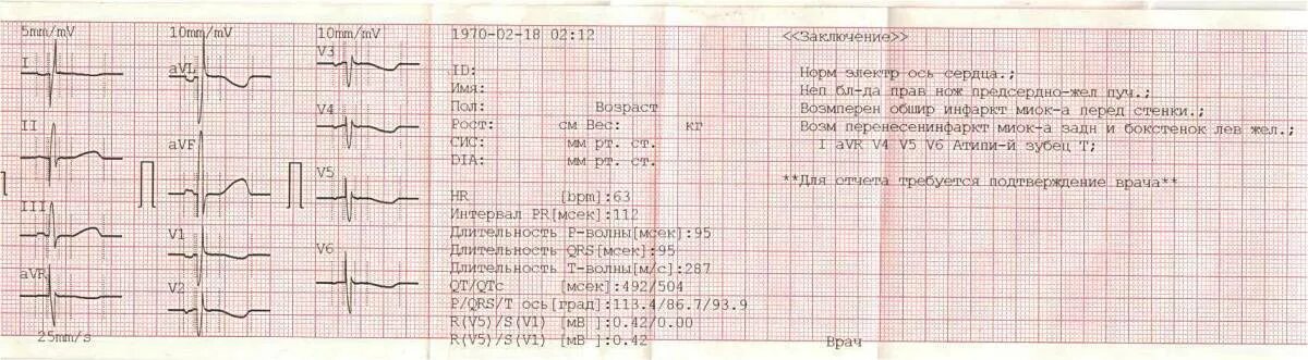 Кардиограмма сердца расшифровка норма у взрослых. Расшифровка экг показатели нормы. кардиограмма сердца расшифровка норма. нормальные показания экг сердца. ось qrs норма экг.