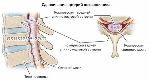 Может ли остеохондроз повысить давление