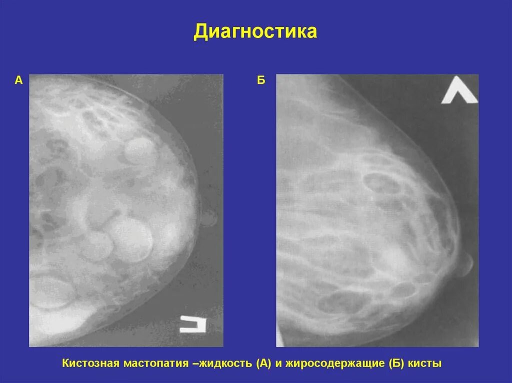 Признаки фиброзных изменений молочных. Фиброзно-кистозная мастопатия. Кистозная мастопатия молочных желез. Диффузная фиброзно-кистозная мастопатия. Маммография выявила фиброзно кистозная мастопатия.