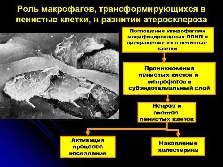 Роль макрофагов в развитии атеросклероза.. Пенистые ксантомные клетки при атеросклерозе. Патогенез атеросклероза пенистые клетки. Патогенез атеросклероза макрофаги. Роль макрофагов