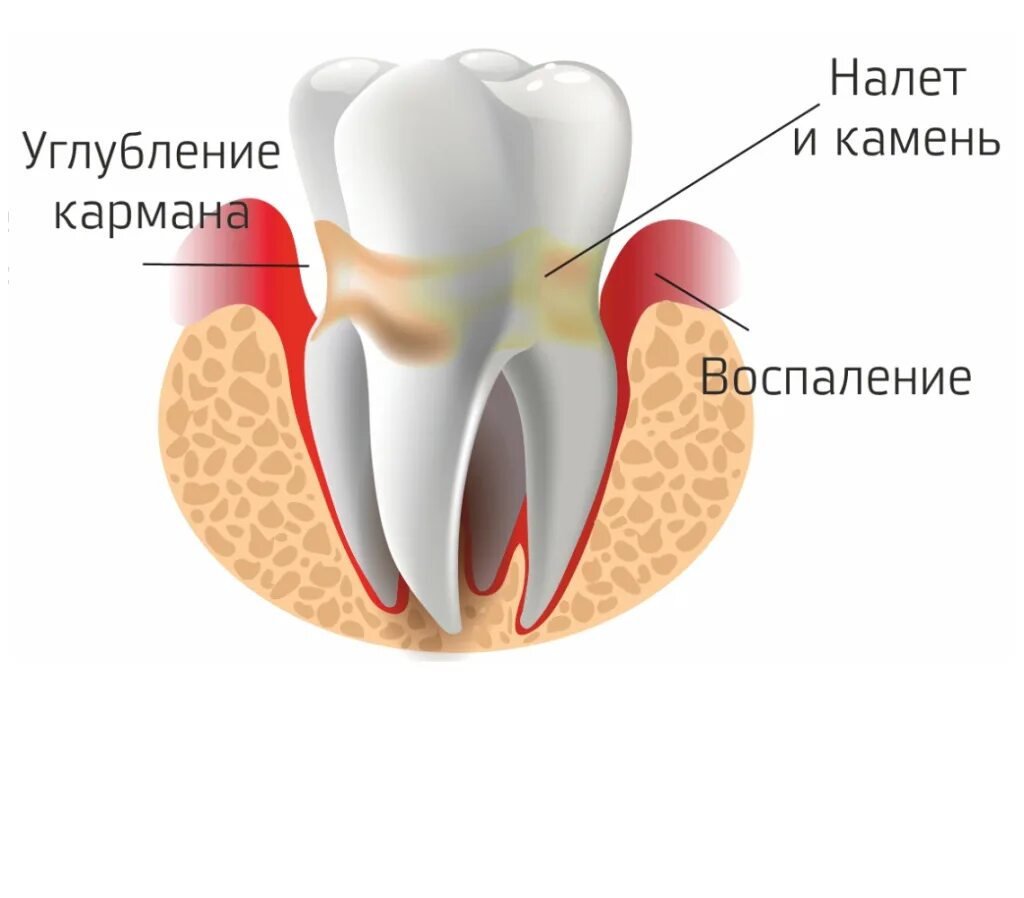 Осложнение лечения периодонтита