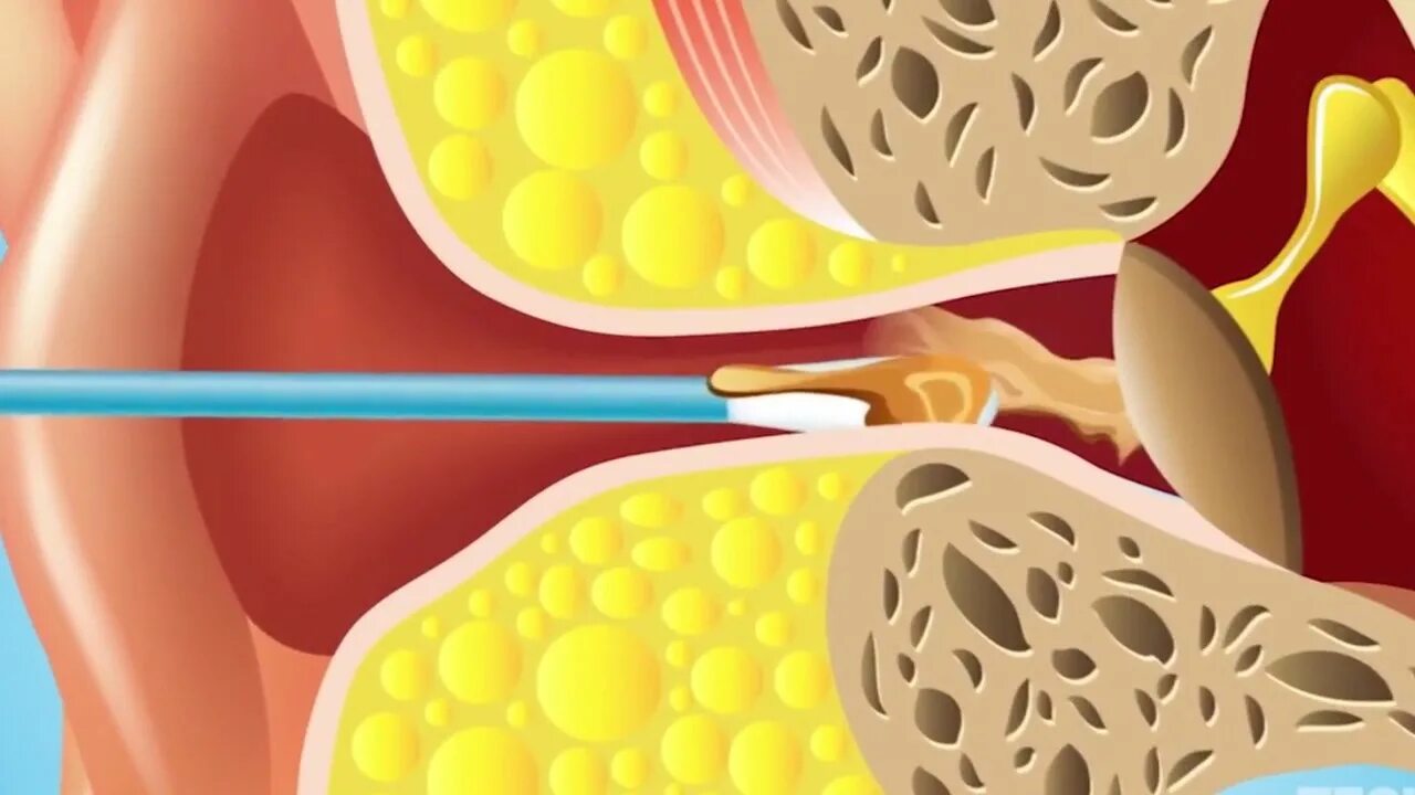 Серная пробка ушная палочка. Серная пробка ватные палочки. Серная пробка на барабанной перепонке. Серо чистить