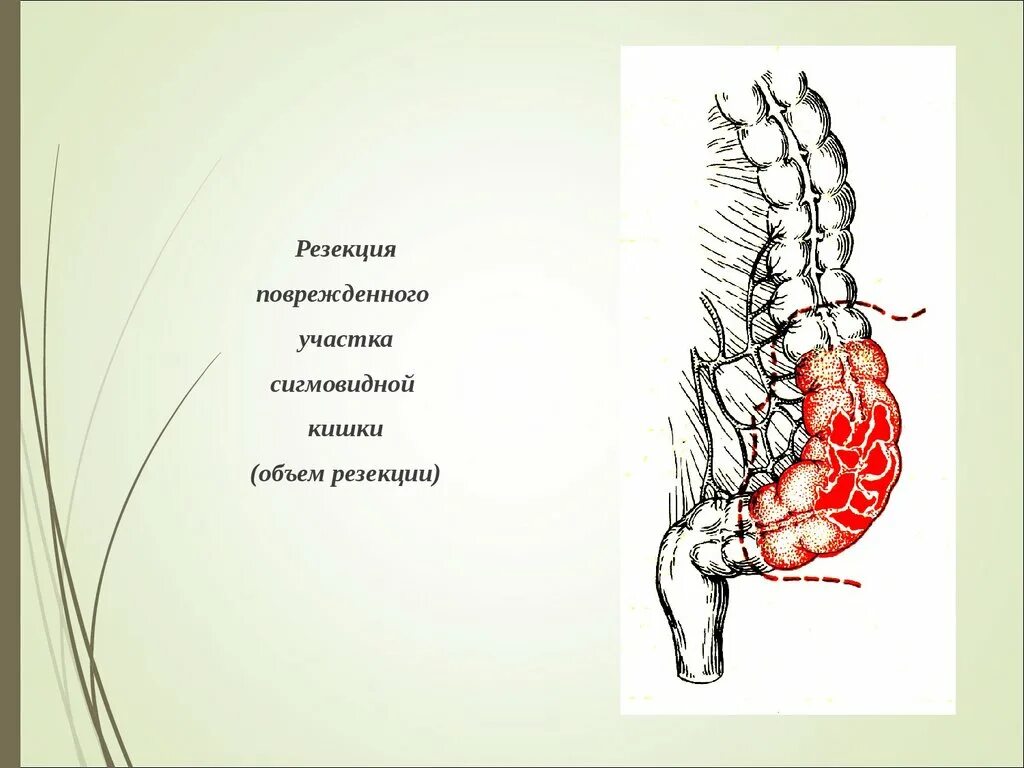 Субтотальная резекция желудка. Резекция перешейка щитовидной железы. Бильрот 1 и 2 техника операции. Резекция объем. Резекция объем.